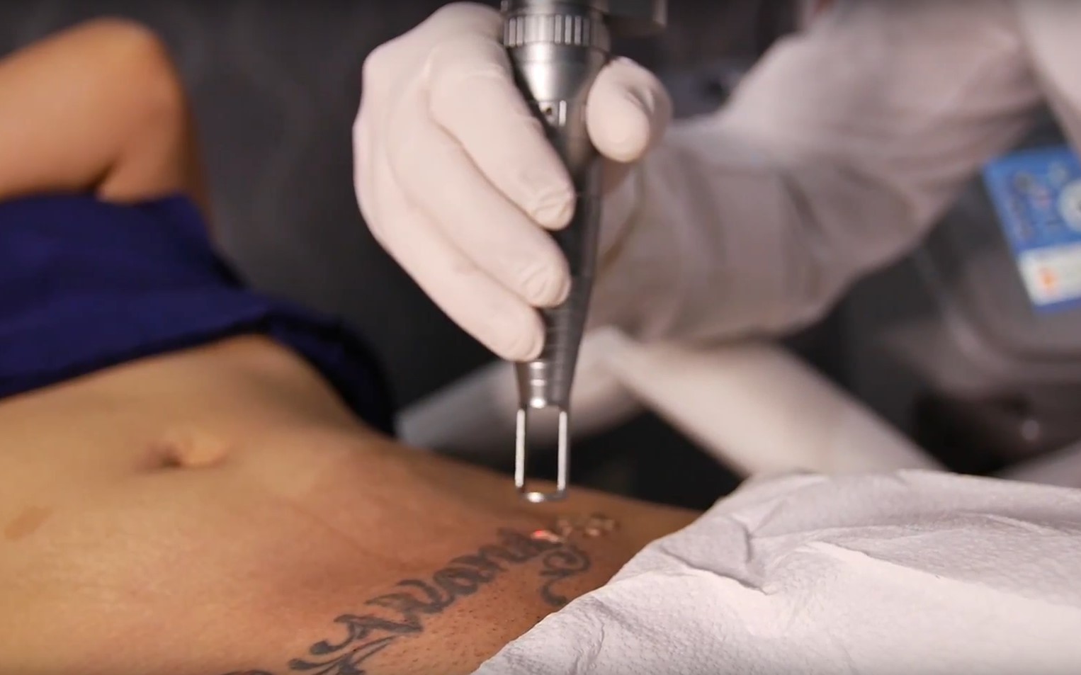 How Laser Tattoo Removal Can Change Your Life in Dubai