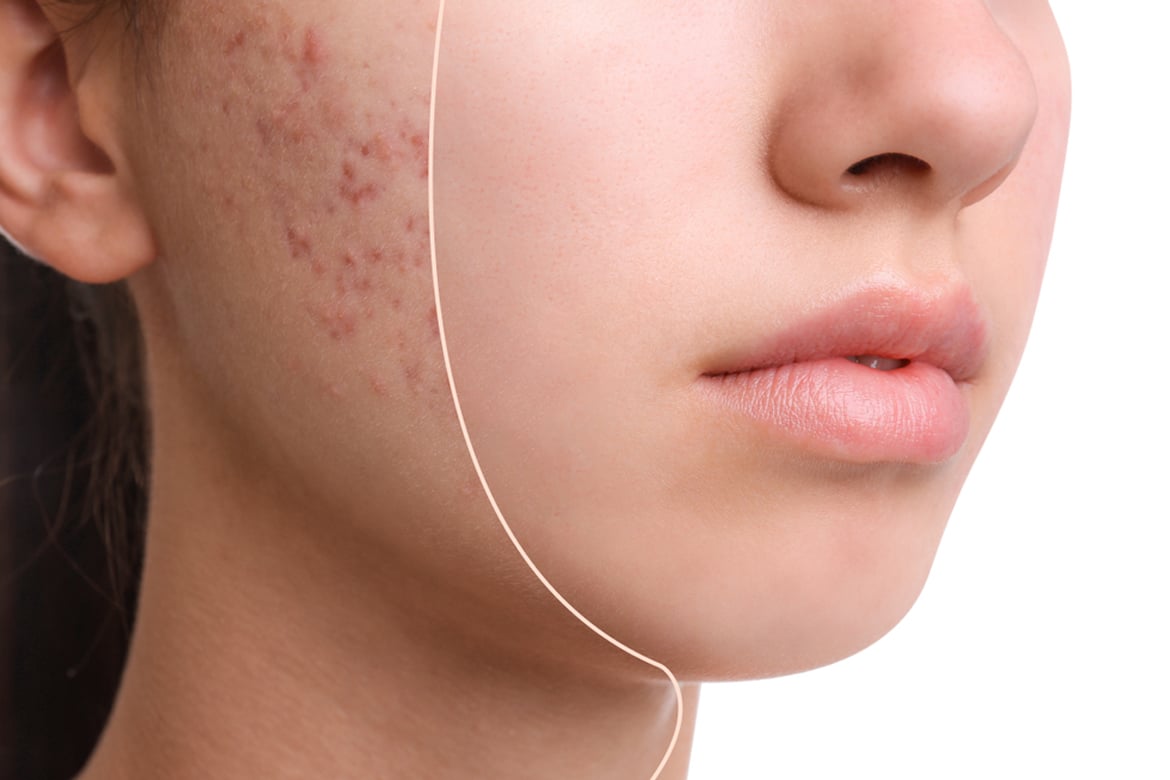 Hydrafacial for Acne Scars A Popular Dubai Beauty Secret