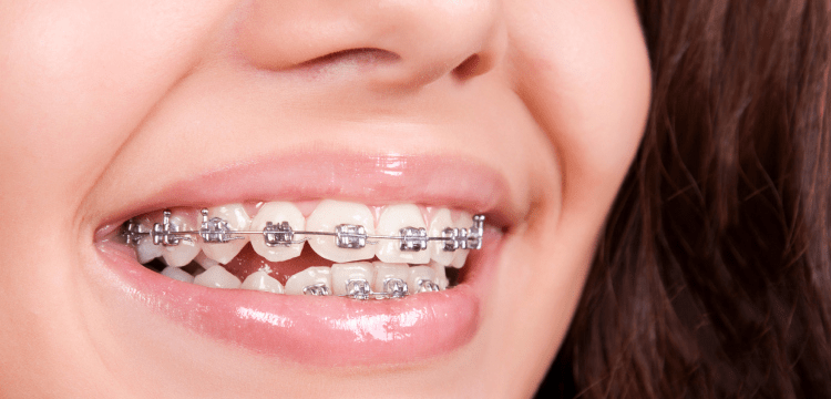 Dealing with Braces Pain: Tips for Comfort During Treatment