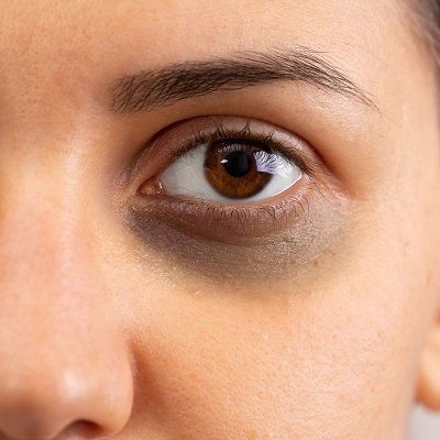 What Causes Dark Circles Treatment Issues?