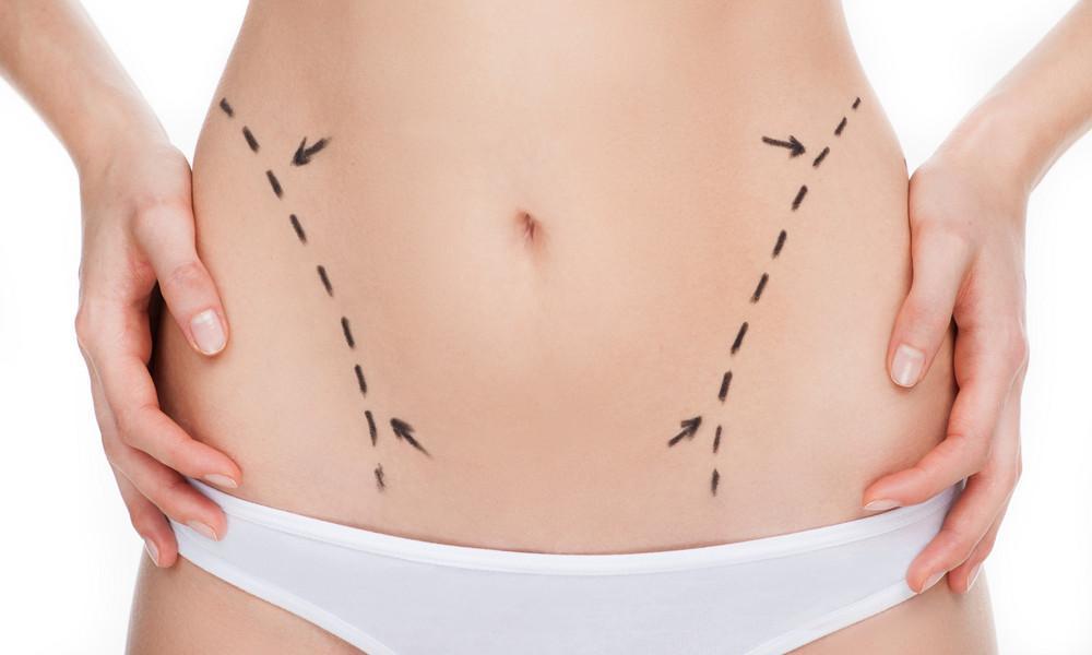 What to Expect During Your Tummy Tuck Consultation