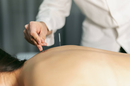 Acupuncture Dover: A Natural Path to Wellness and Pain Relief