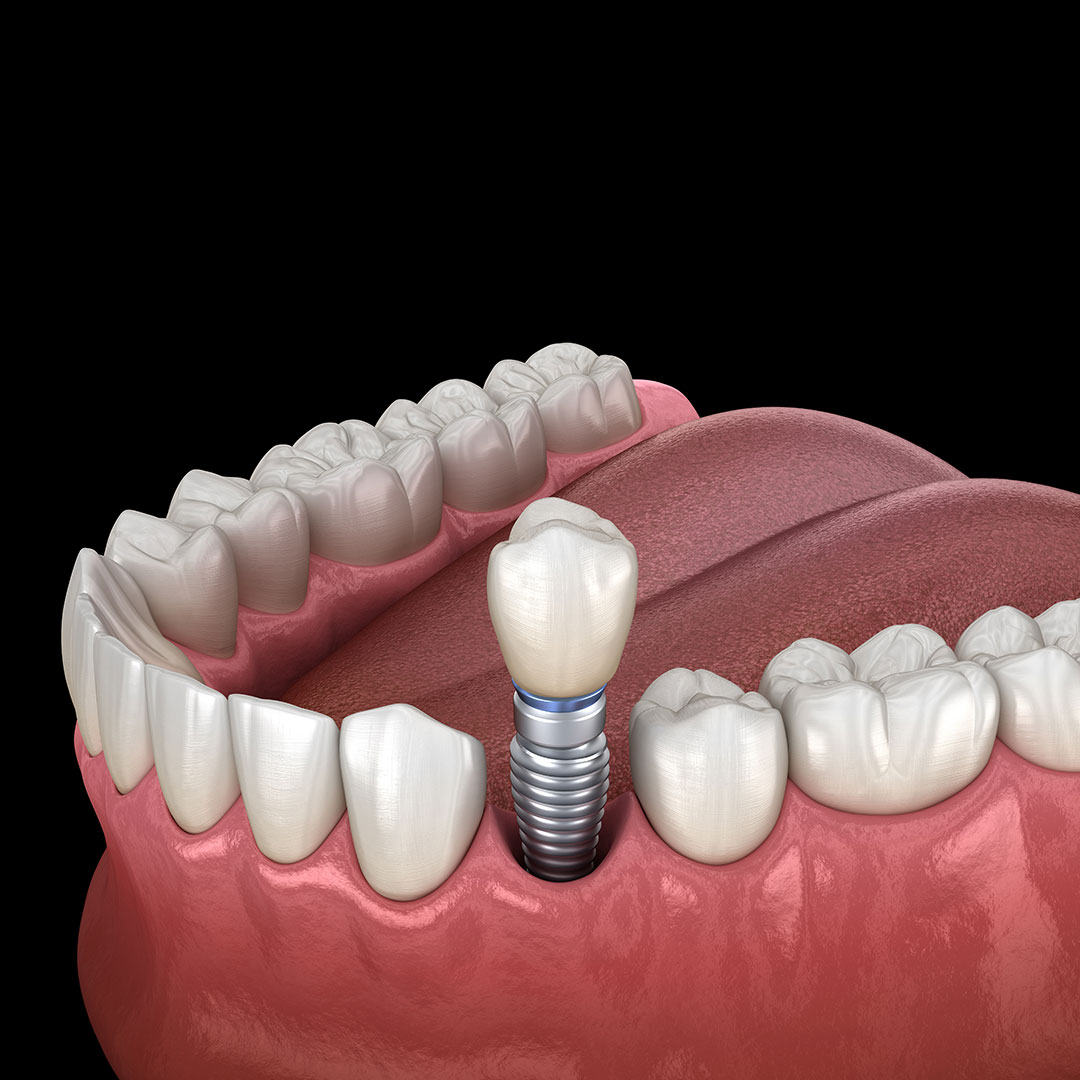 How Same-Day Dental Implants Can Transform Your Smile in One Visit