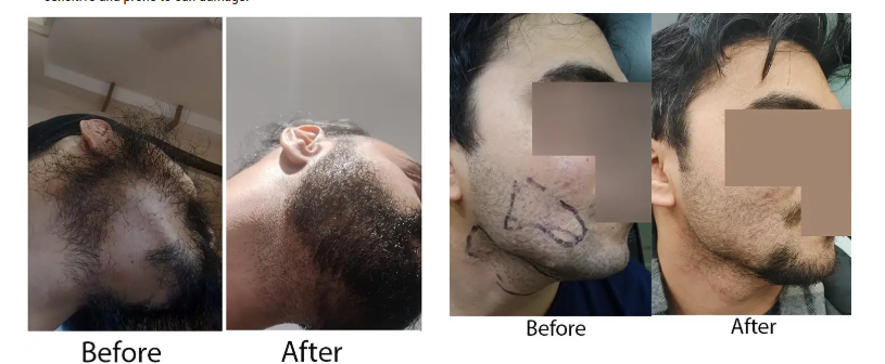Beard Hair Transplant in Delhi, Hair Transplant in India