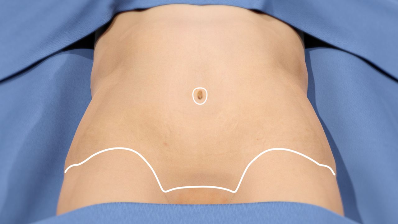 When Is the Right Time for a Tummy Tuck?