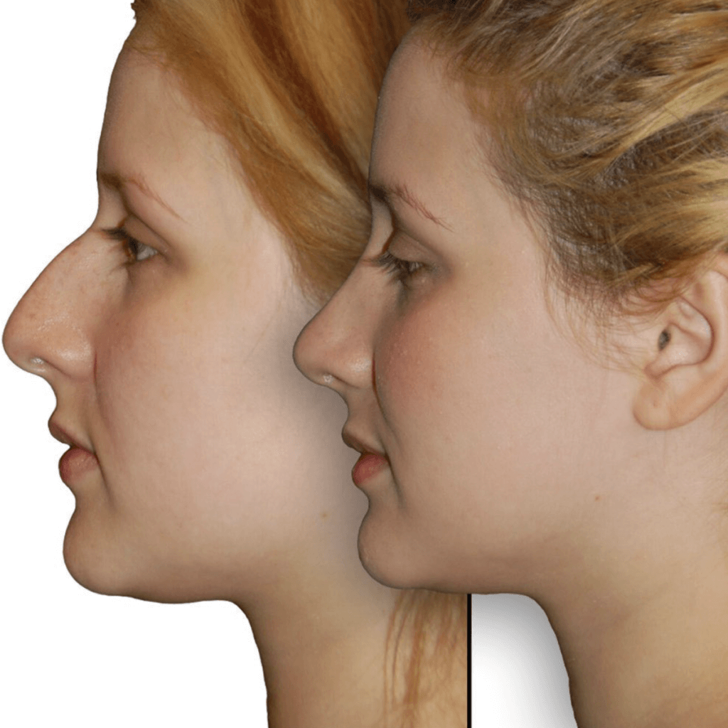 Securing the Best Nose Position Specialist in Chicago