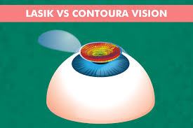 Differences Between Contoura Vision Surgery and LASIK Surgery