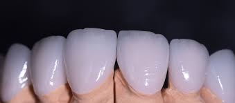 Perfect Your Teeth with Cutting-Edge E-Max Veneers