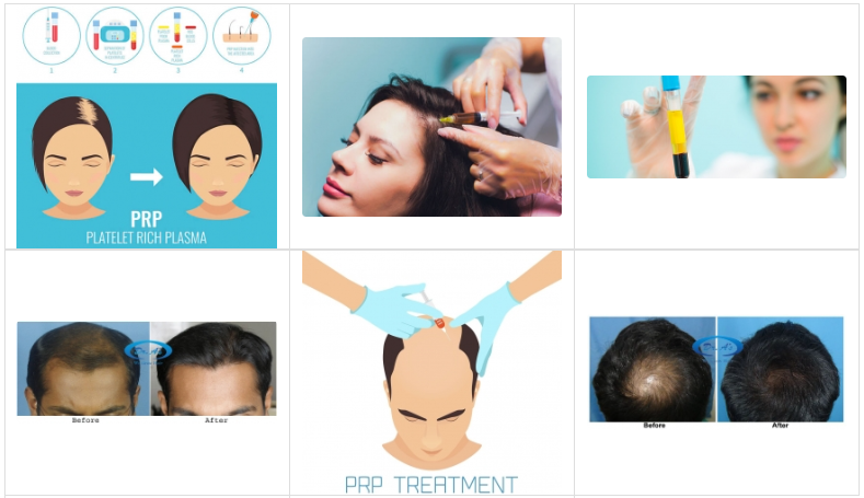 Prp Hair Treatment in Delhi, Hair Transplant in India