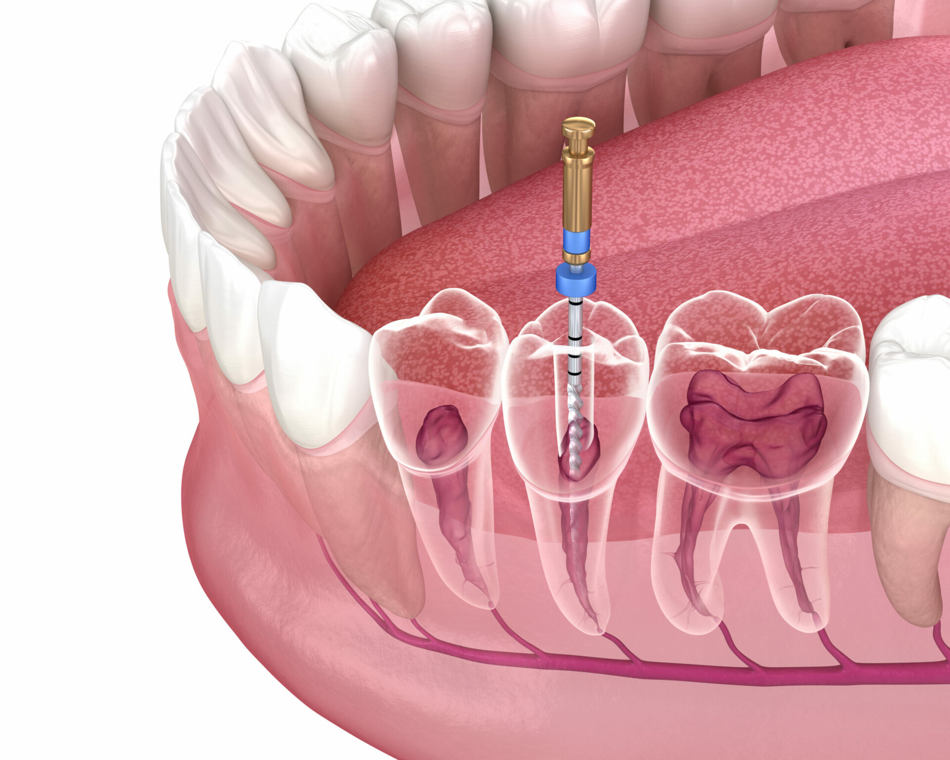 Same Day Dental Implants: Instant Smile Restoration in One Visit