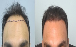 Affordable Hair Transplant in Dubai – Natural & Permanent Results