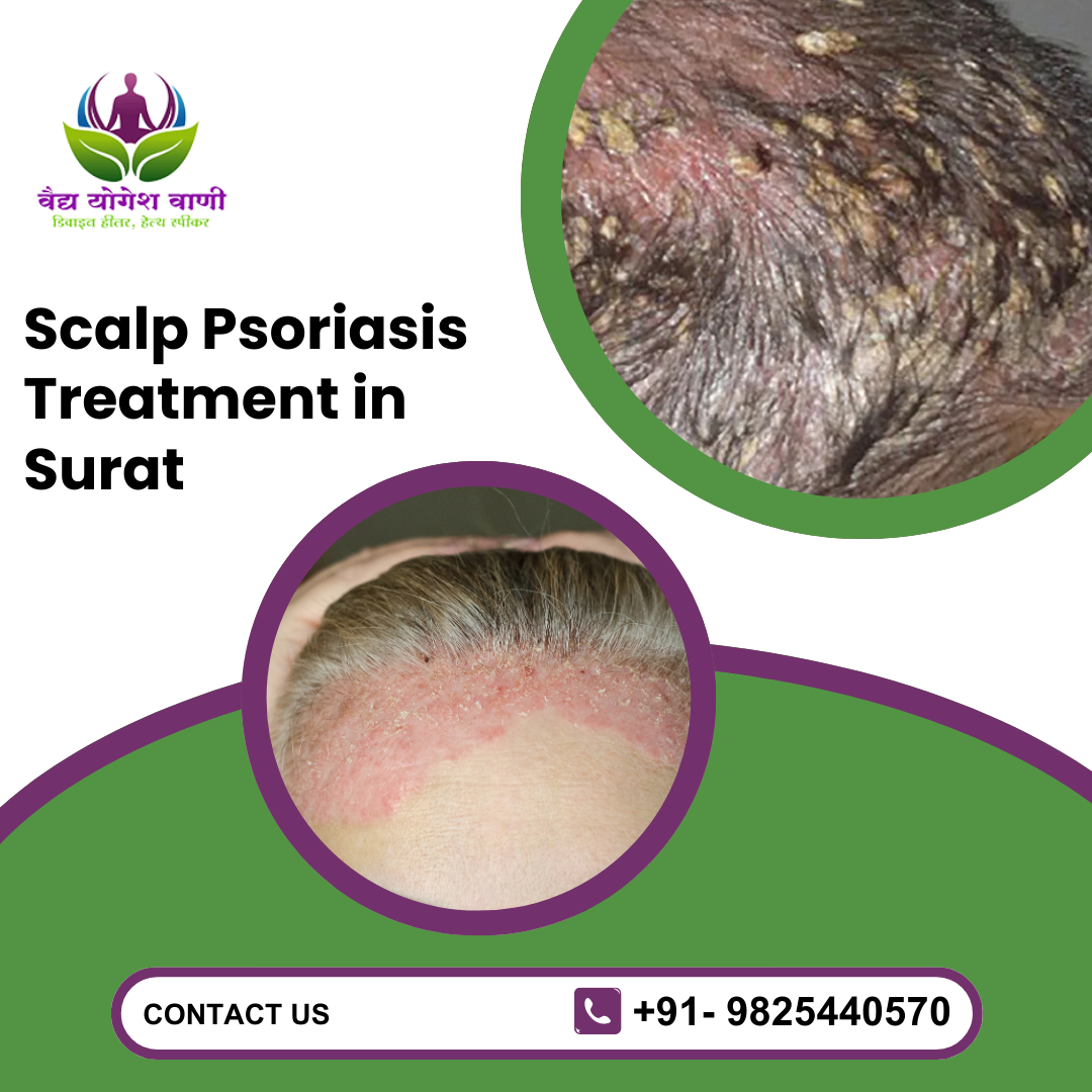 Where Can You Find Effective Scalp Psoriasis Treatment in Surat