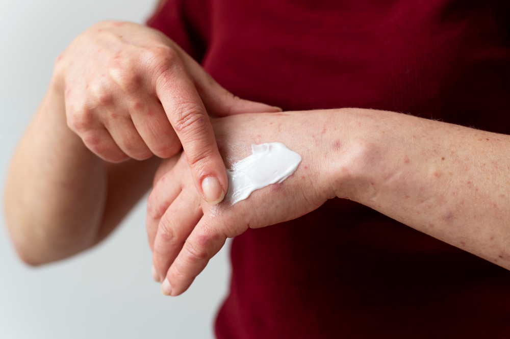 Get Rid of Eczema, Psoriasis, and Ichthyosis with Natural Skin Care Products