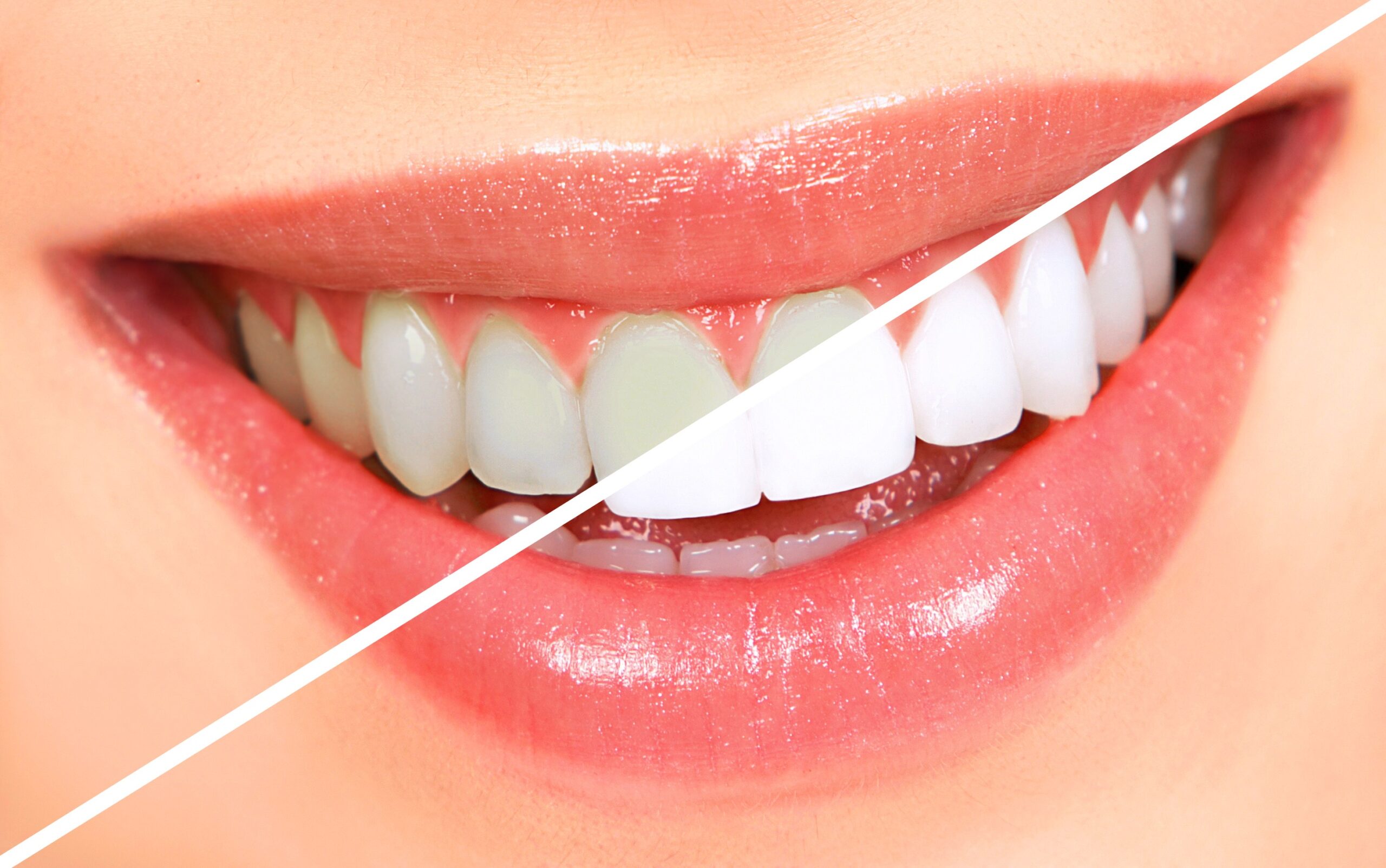 How to Combine Flossing with Teeth Whitening