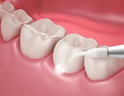 Pain-Free Wisdom Teeth Removal in Hornsby: Expert Care at Whitecross Dental