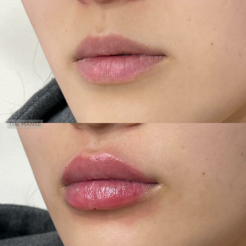 The Ultimate Guide to Lip Fillers: Everything You Need to Know