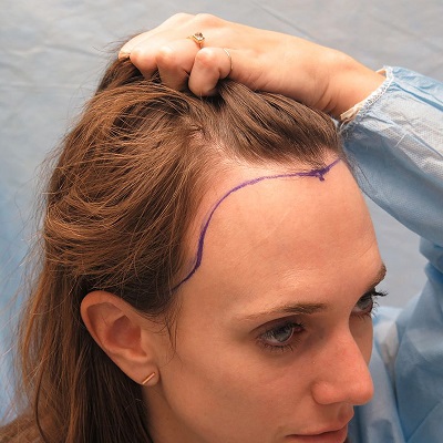 The Ultimate Guide to Hair Restoration in Islamabad