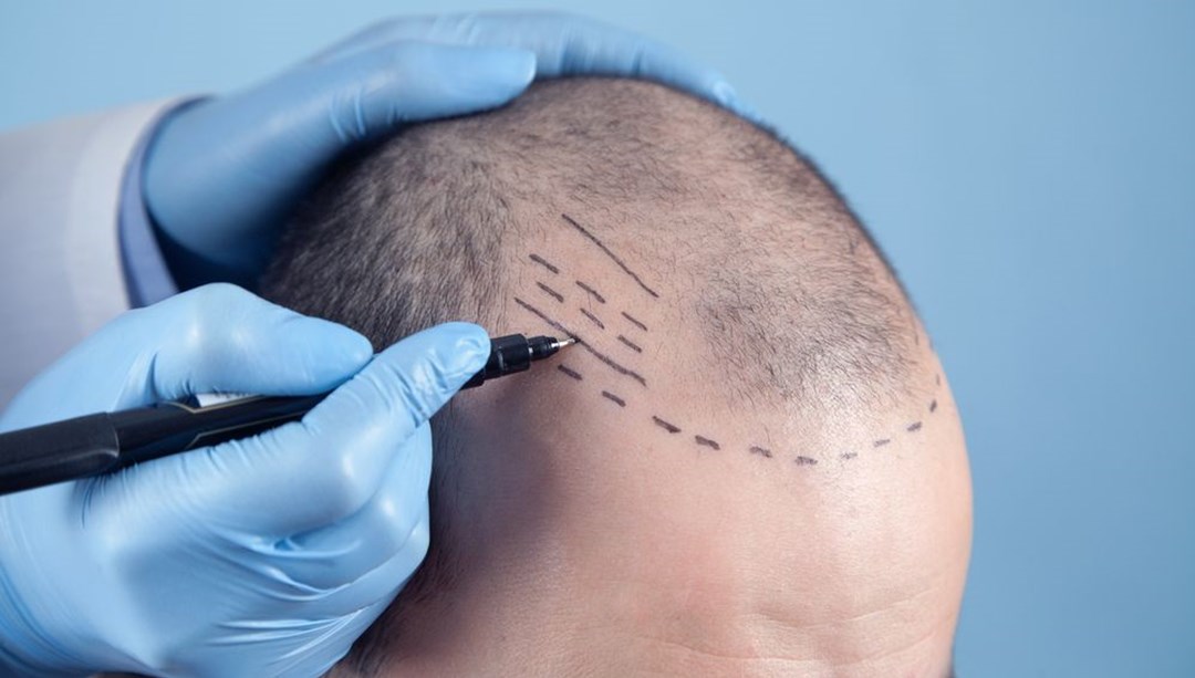 How a Hair Transplant Can Change Your Appearance