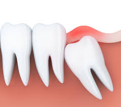 Expert Wisdom Teeth Removal in Hornsby: Pain-Free Solutions by Whitecross Dental
