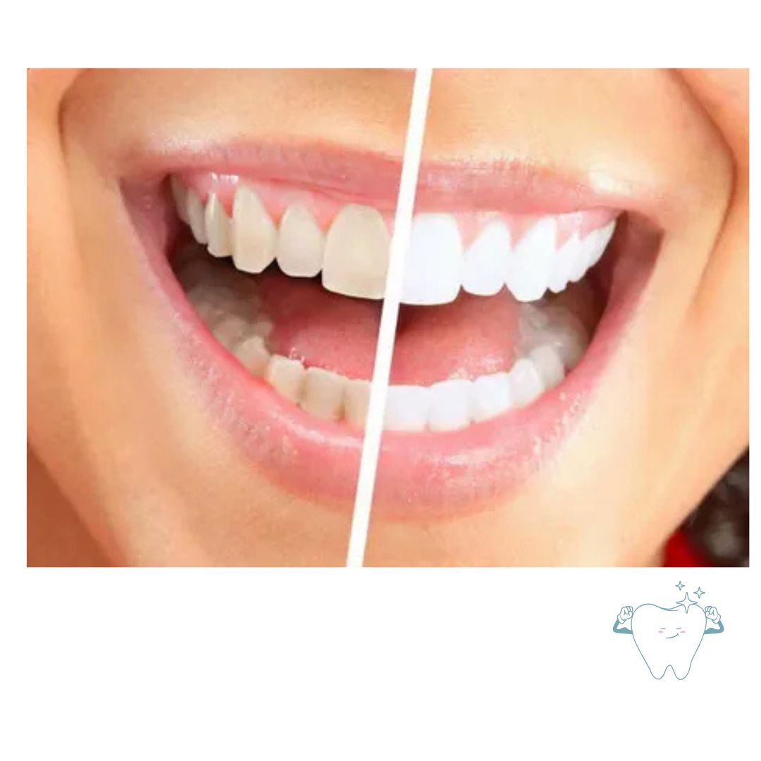 Los Angeles Teeth Whitening Experts &ndash; Safe, Effective, and Affordable!