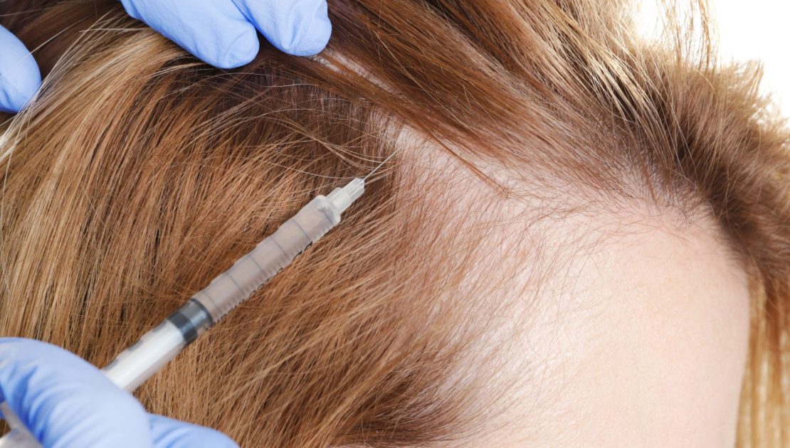 Why Am I Losing More Hair After GFC Treatment for Hair?