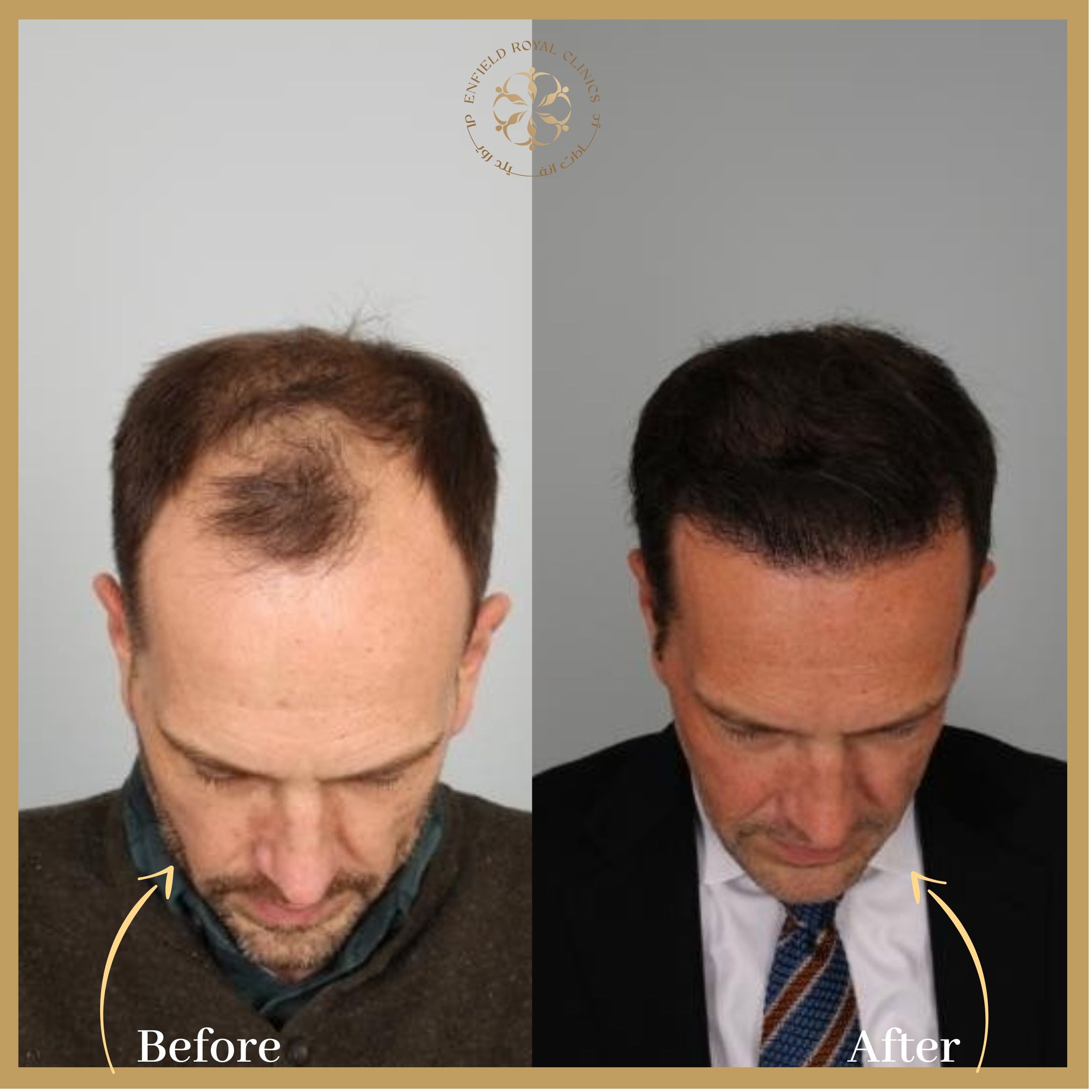 PRP Therapy for Hair Restoration