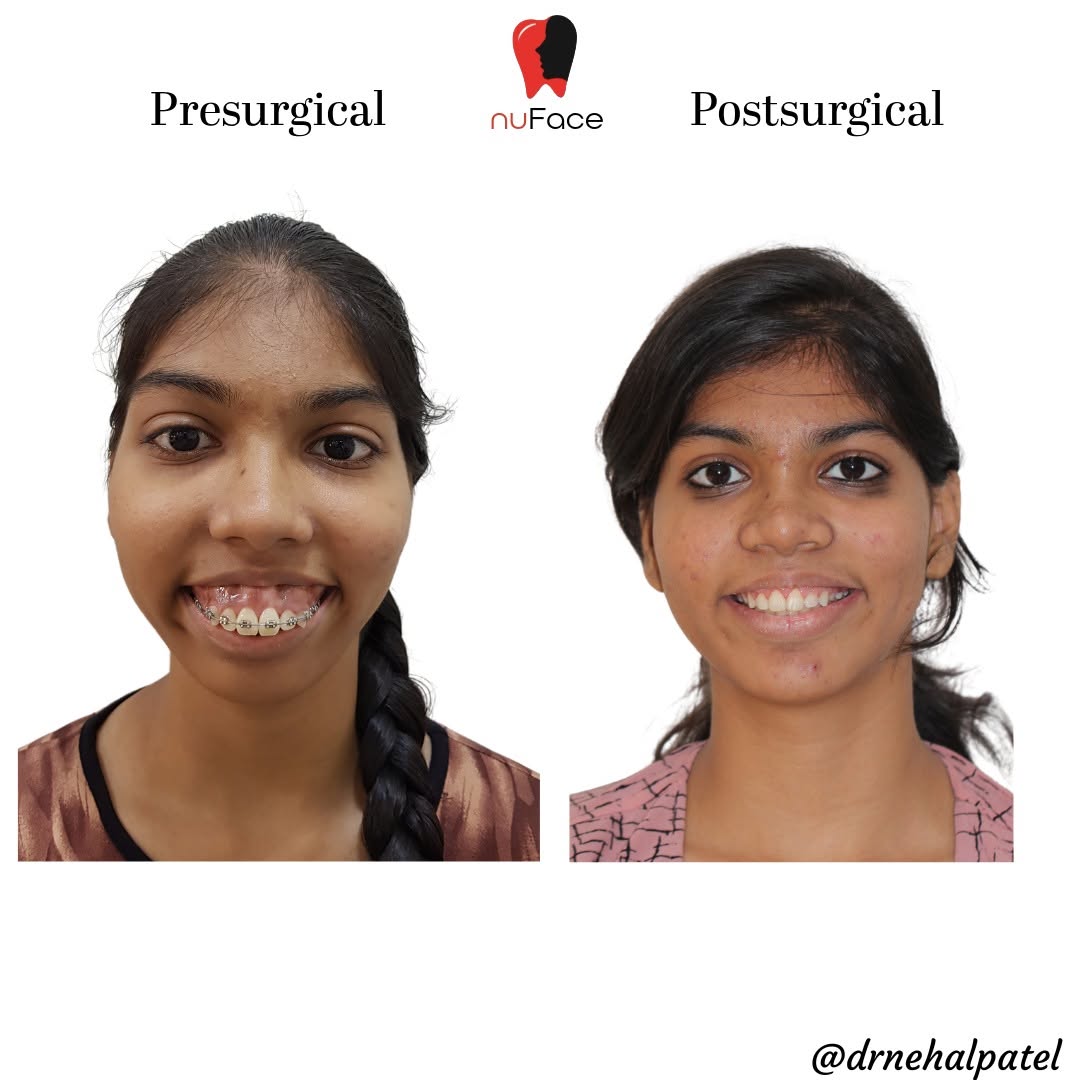 Maxillary Vertical Excess: Causes, Treatment, and How Orthognathic Surgery Can Help