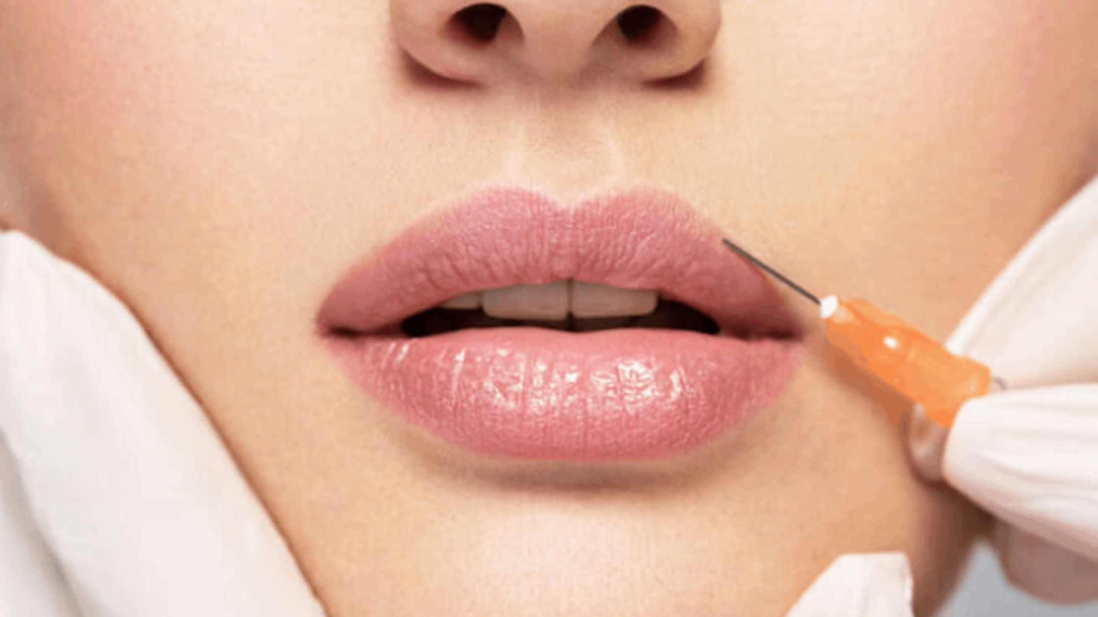 Best Treatment for Wrinkles Around the Mouth: A Comprehensive Solution