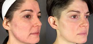 Botox Deals Near Me: How to Find the Best Discounts on Botox Treatments