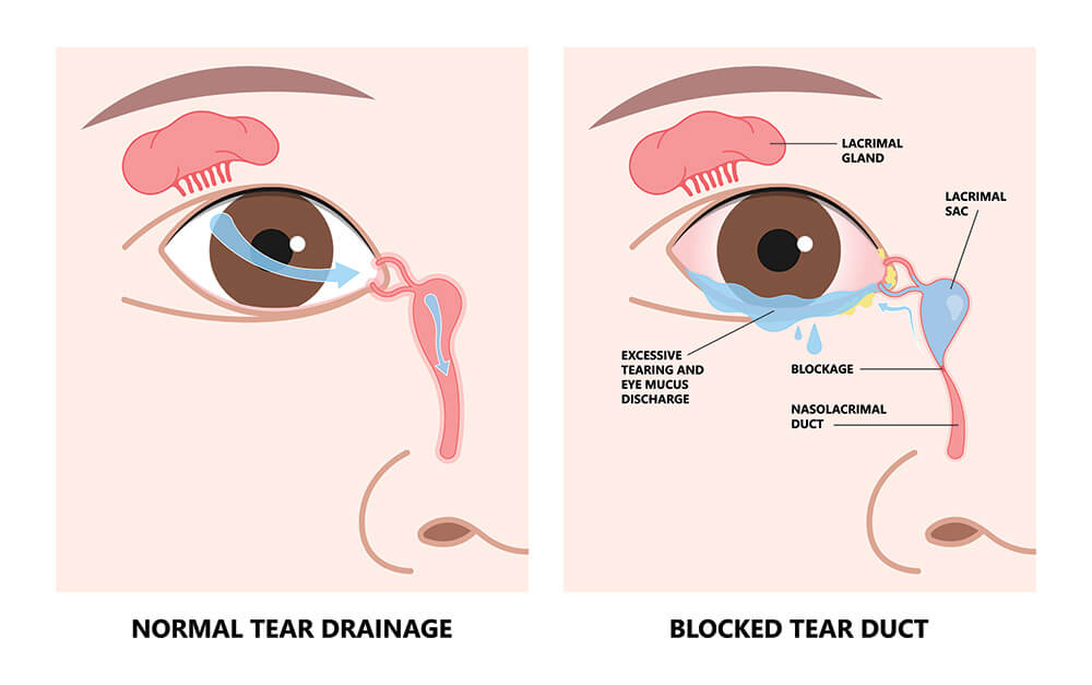 Blocked Tear Duct: Causes, Symptoms, and Treatment Options