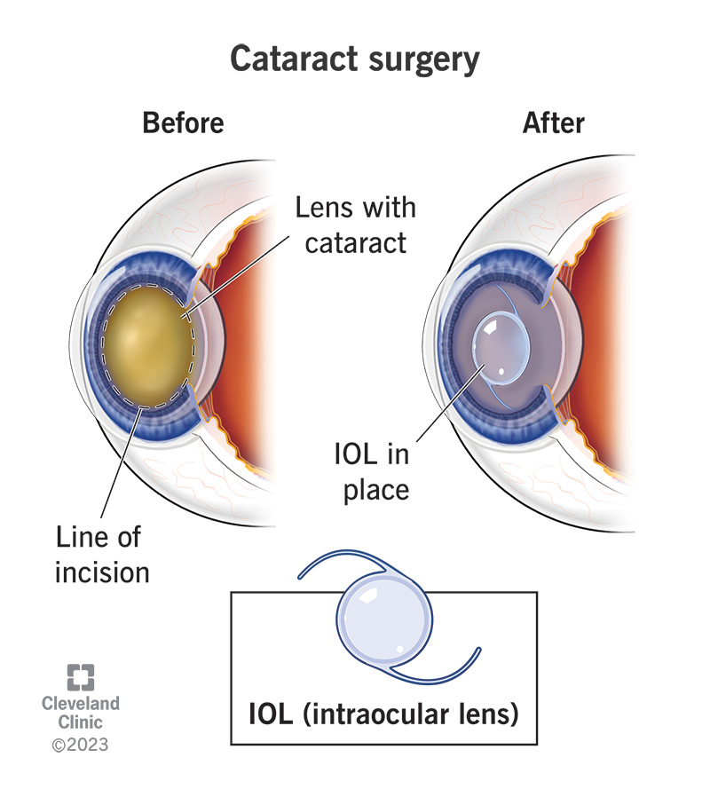 Cataract Surgery: Risks, Recovery, and Costs
