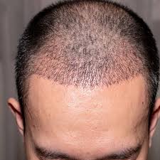 Hair Transplant in Noida: The Expertise of Dr. Amit Gupta in Restoring Confidence