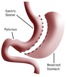 Gastric Sleeve Surgery in Riyadh: A Permanent Weight Loss Solution?