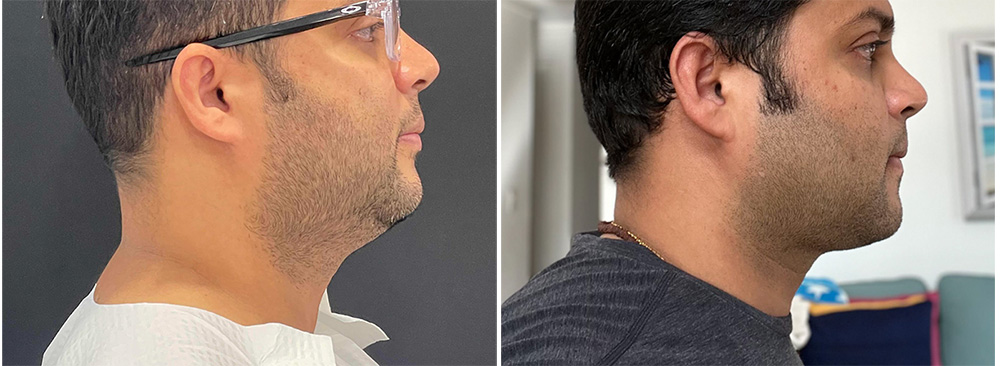 Eliminate Your Double Chin with Chin Lipo Near You