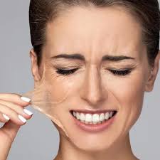 Transform Your Skin: The Benefits of Chemical Peels Explained