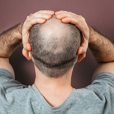 Achieve Natural-Looking Hair Restoration in Riyadh"