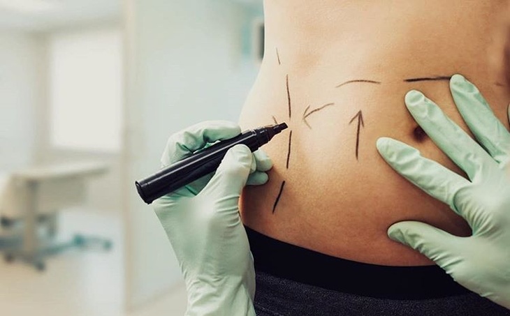 Liposuction for Women: Target Areas