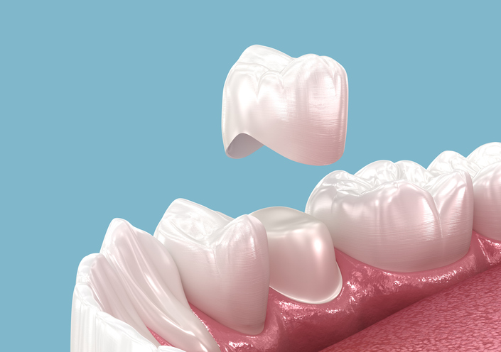 Your Ultimate Guide to Dental Crowns