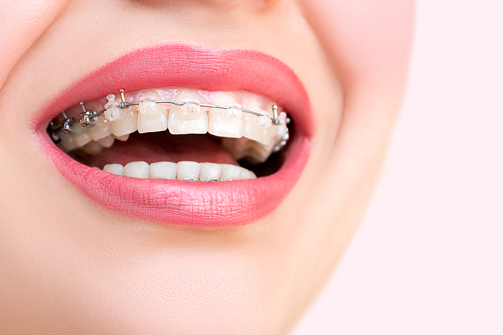 Finding the Best Braces for Your Budget in Riyadh