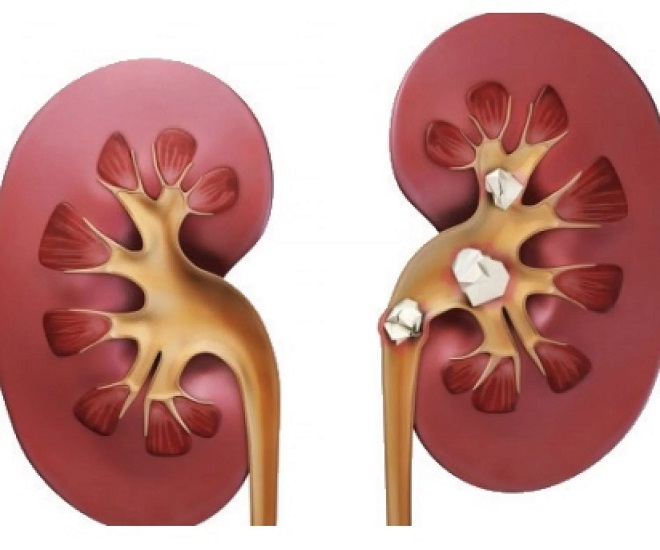 Discover Ayurvedic Treatments for Kidney Stones at Aksa Ayurveda