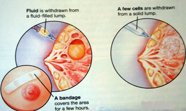 How Doctors Use Biopsy for Diagnostic Purposes to Confirm Diseases