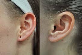 Can I Reverse Stretched Earlobes from Gauges With Surgery in Dubai