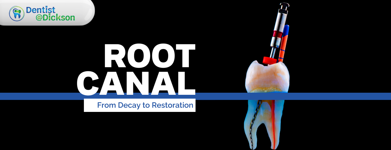 From Decay to Restoration: How a Root Canal Can Save Your Tooth?