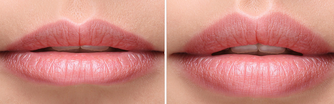 Russian Lip Filler Procedure: Step-by-Step Guide in Riyadh