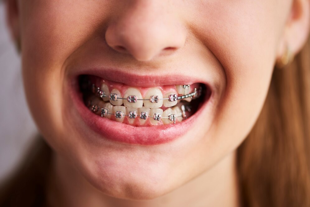 What Are Champagne Braces and How Do They Work?