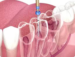 Is Root Canal Treatment Painful? Myths vs. Reality