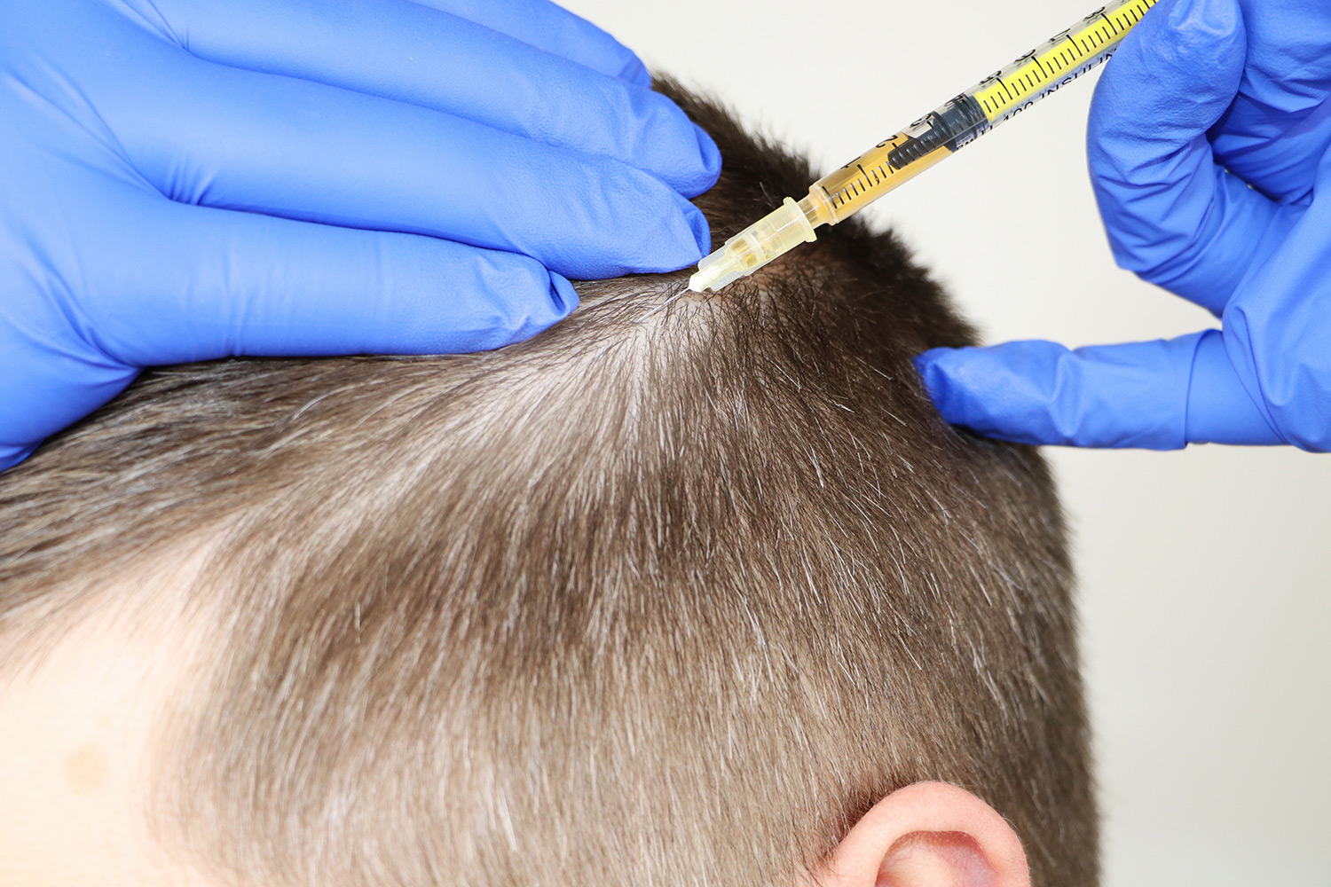 Who is a Good Candidate for GFC Hair Transplant in Riyadh?