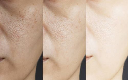 Different Types of Lasers for Melasma Treatments