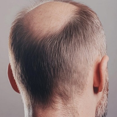 Crown Hair Transplant for Men vs. Women: Key Differences