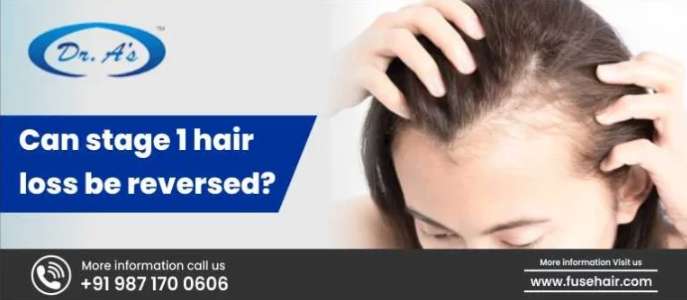 Stage 1 Hair Loss, Best Hair Transplant in India